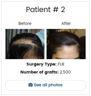 Female Hair Transplant Before and After Gallery | FUE Before After