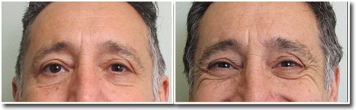 Eyebrow Hair Transplant | San Diego, CA | Eyebrow Restoration