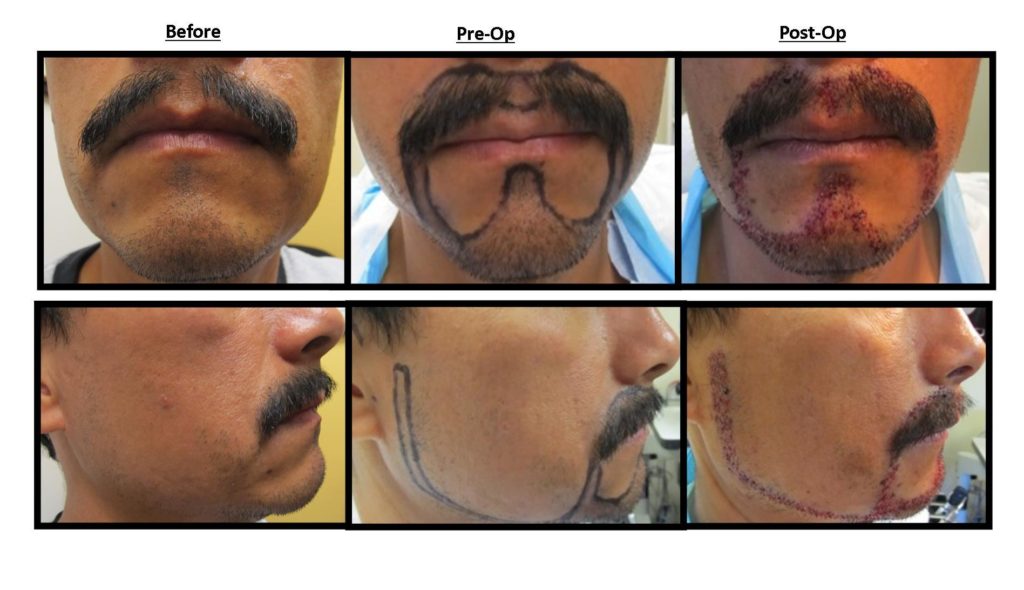 Facial Hair Transplant | San Diego, CA | My Hair Transplant MD