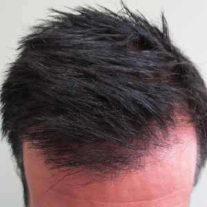 New Men's Photo Gallery - My Hair Transplant MD